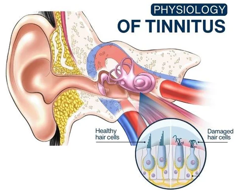 AEXZR™ Ear Acupoint Tinnitus Relief