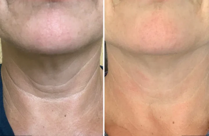 Biancat® BeeLixir Neck Firming Stick