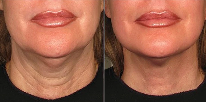 Biancat® NeckYouth Peptide Anti-Wrinkle Patch