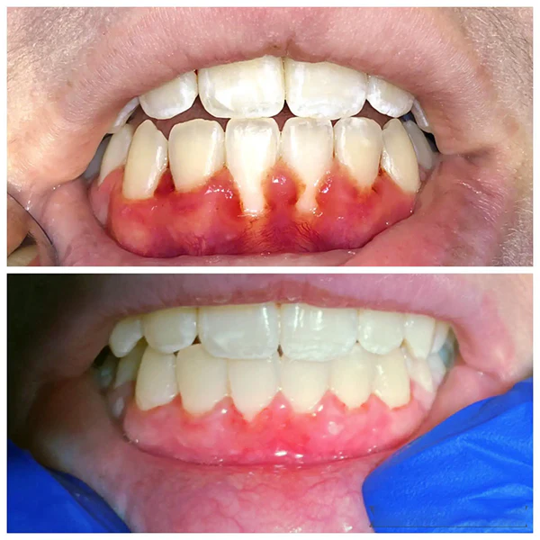 Cvreoz® Oral Solution Spray