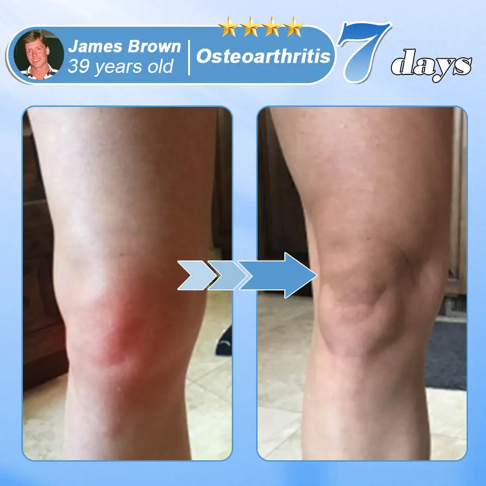 EQVP® Hyaluronic Acid Nano-microneedle joint patch