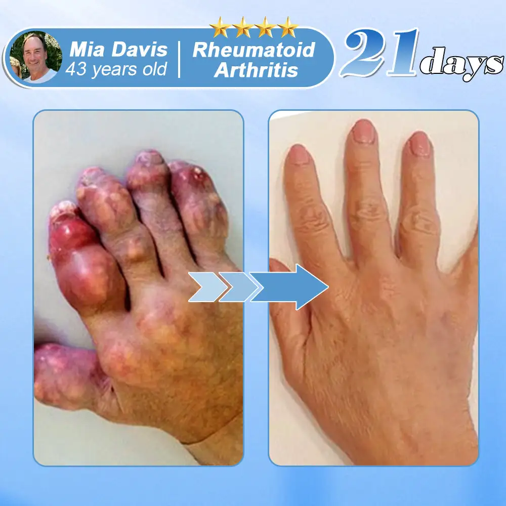 EQVP® Hyaluronic Acid Nano-microneedle joint patch