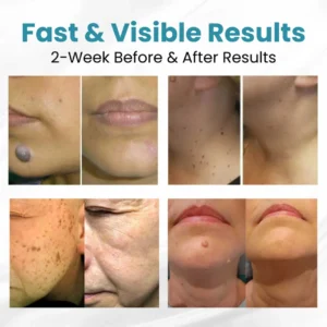 Lovilds® Non-Invasive Mole and Wart Removal Laser Pen