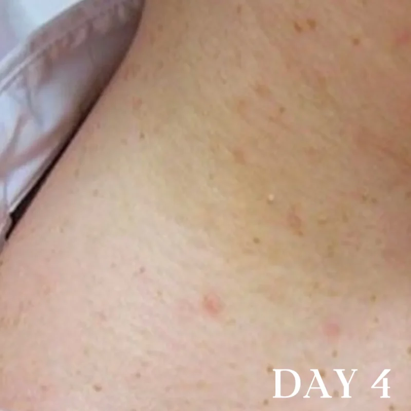 Oveallgo® DermaErase Advanced Mole & Spot Removal Gel