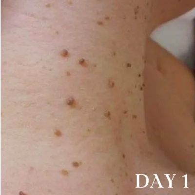 Oveallgo® DermaErase Advanced Mole & Spot Removal Gel