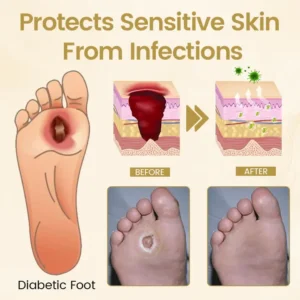 Timilk® Diabetic Foot Healing Spray - Bee Venom Infused