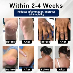 ATTDX® BeeEase MicroSting Joint Patches