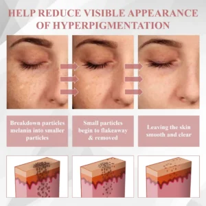 ATTDX® NanoDart Skin Tag Removal Patches