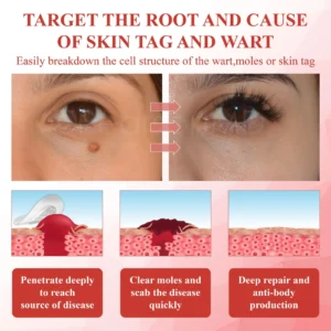 ATTDX® NanoDart Skin Tag Removal Patches