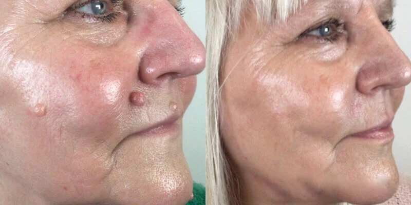 Bikenda® DermZap Mole & Wart Removal Laser Pen