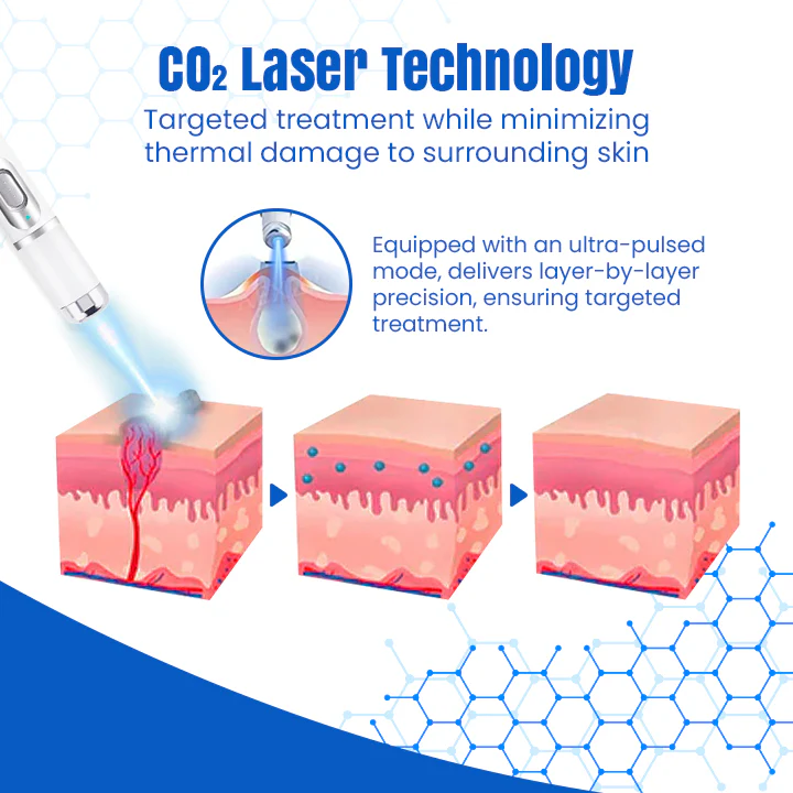 Bikenda® DermZap Mole & Wart Removal Laser Pen