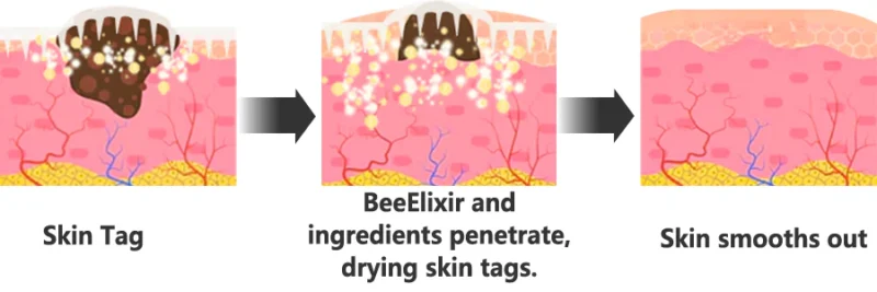 DIVIFIT™ BeePure MicroDart Patch