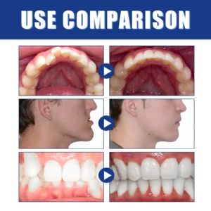 Vaxflite™Mandibular Corrector-For a Healthier, More Aligned Smile
