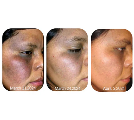 Winter Sale AEXZR® Herbal Spots Peel-Off Facial Mask