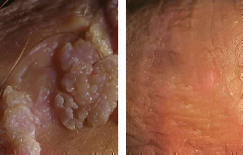 Cvreoz® HPV Genital Warts Relief Cream