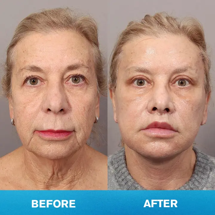 LIMETOW® Invisible Face Lift Tape