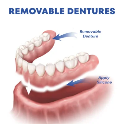 NESLEMY™ Thermoplastic Denture Adhesive