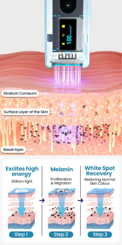 Nurbini® Dermiglow Vitiligo Therapy device