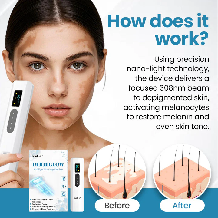 Nurbini® Dermiglow Vitiligo Therapy device