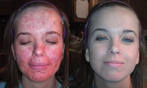 【REBYIPO® Official Store】Ruxolitinib Multieffect Repair Cream