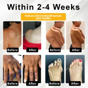 ATTDX® PuffEase Edema Therapy Massage Cream