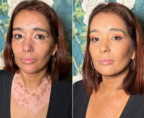 Bikenda® Vitiligo Light Therapy Device
