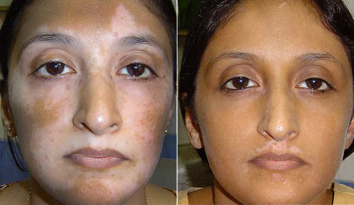 Bikenda® Vitiligo Light Therapy Device