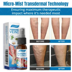 Cvreoz® Varicose Veins Comfort Spray