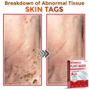 Juxek™ MicroNeedle Plant-based Skin Tag Removal Patch Made in the USA