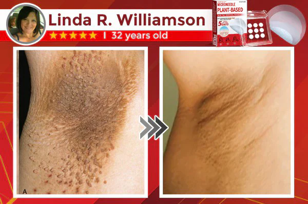 Juxek™ MicroNeedle Plant-based Skin Tag Removal Patch Made in the USA