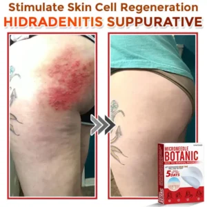 LOVILDS® MicroNeedle Botanic Skin Tag Removal Patch