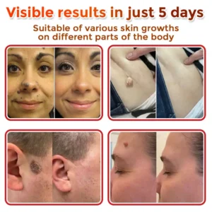 LOVILDS® MicroNeedle Botanic Skin Tag Removal Patch