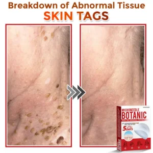 LOVILDS® MicroNeedle Botanic Skin Tag Removal Patch