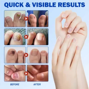 Nail Health Care Patches – Repair and Strengthen Weak Nails