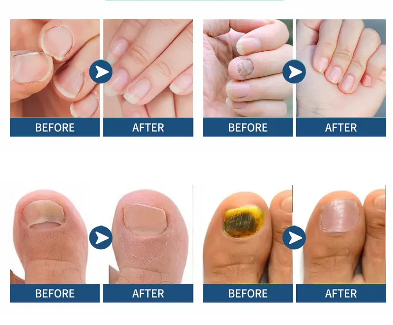 Nail Health Care Patches – Repair and Strengthen Weak Nails